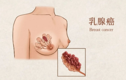 保乳手术：乳腺癌治疗的另一种选择